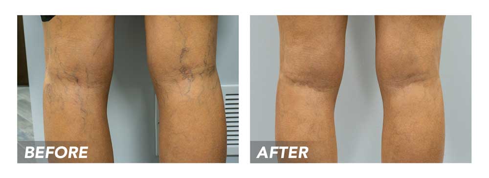 How Can I Find a Spider Vein Clinic Near Me in Texas 2020?