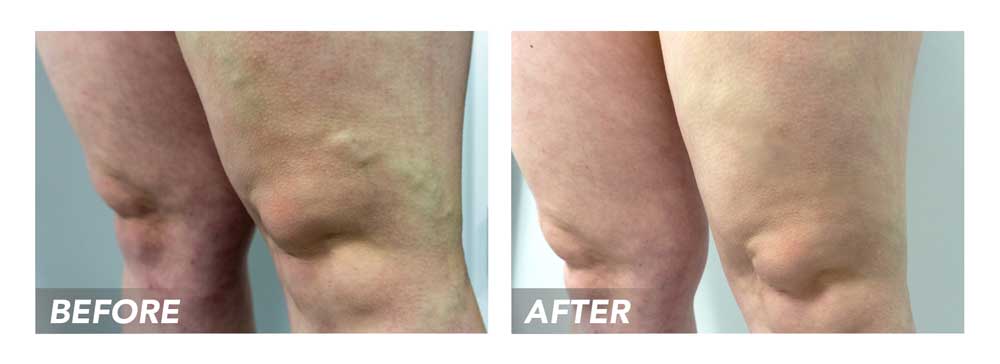 Before-After-VaricoseVeins-Patient4B Before-After-VaricoseVeins-Patient4B