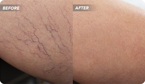 How Can I Find a Varicose Vein Clinic Near Me in TX?