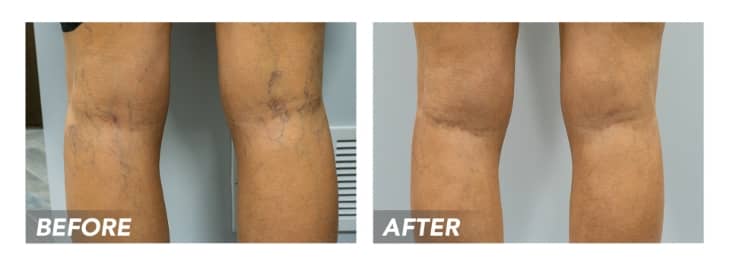 What are the Best Treatments for Vein Relief in Houston?