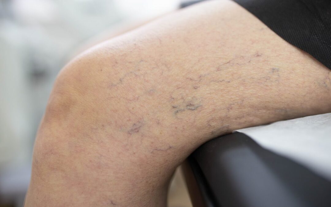 Who is the Most Reputable Vein Doc Near Me in Texas?