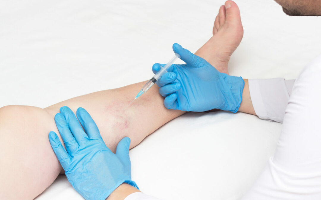 What Does a Vein Clinic Do? Top Vein-Related FAQs, Answered