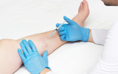 What Does a Vein Clinic Do? Top Vein-Related FAQs, Answered