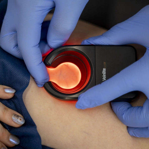 Dr_Byron_veinlite_optimized_optimized What does a vein clinic do